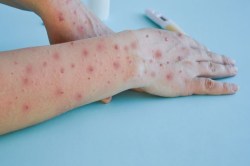 Monkeypox Virus: जयपुर में मंकी पॉक्स की दस्तक! एयरपोर्ट पर हड़कंप, दुबई से लौटा
था मरीज - image