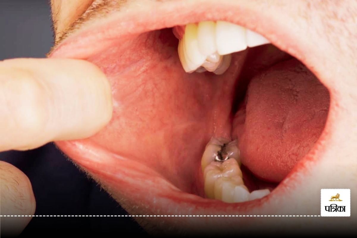 Mouth Cancer Cases in India are the Highest, the Growing Threat of Smokeless
Tobacco