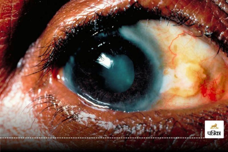 Trachoma free India recognition