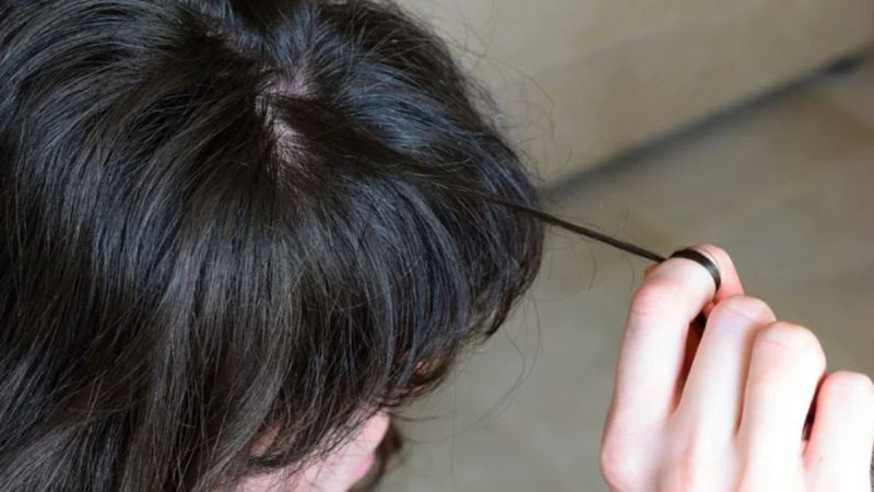 Trichotillomania