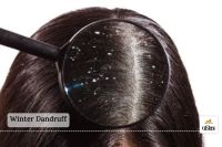 Winter Dandruff To get rid of dandruff these home remedies will give new life to your hair in winter