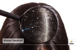 Winter Dandruff: डैंड्रफ से निजात पाने के लिए सर्दियों में ये घरेलू नुस्खे आपके
बालों को देंगे नई जिंदगी - image