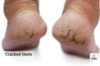 Cracked Heels: How to avoid cracked heels in winter? Know the causes, prevention and treatment