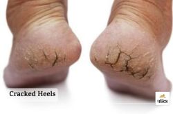 Cracked Heels: सर्दियों में फटी एड़ियों से कैसे बचें? जानिए घरेलू नुस्खे - image