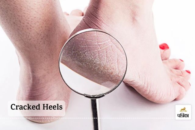 Explore Essential Tips for Prevention and Remedies to Keep Your Feet Smooth and Healthy