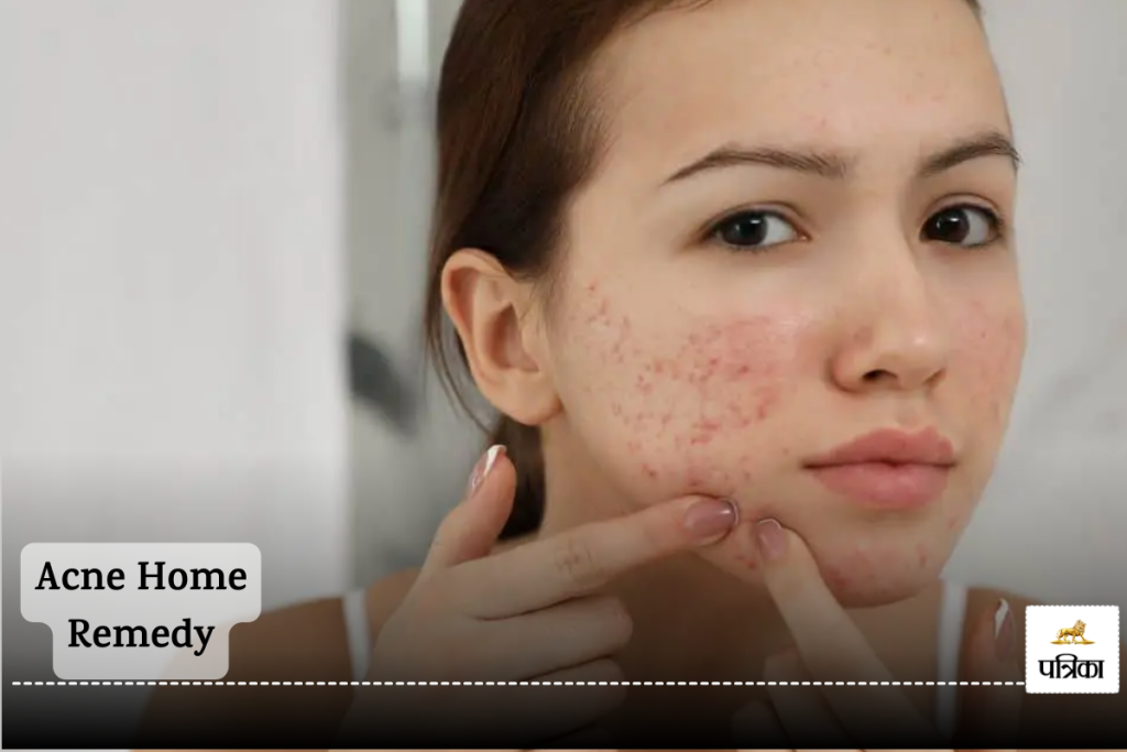 Acne Home Remedy: Don't worry about acne and pimples in winter, adopt these 5 powerful home remedies now.