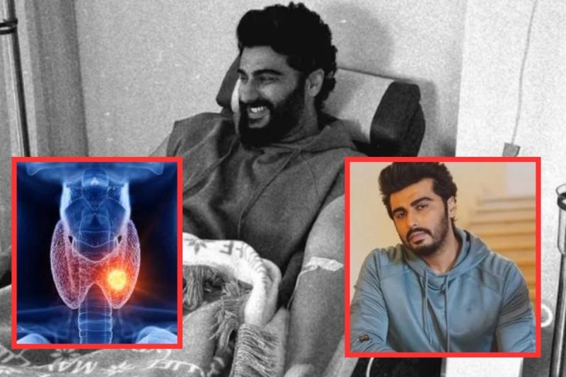 Arjun Kapoor Hashimoto's Disease