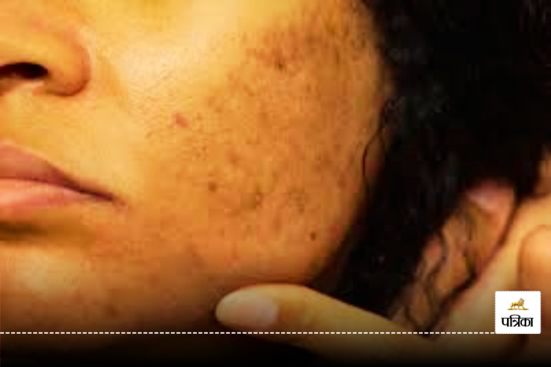 Hyper pigmentation damages the skin, know its causes and prevention