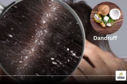 Dandruff: डैंड्रफ की समस्या से हैं परेशान तो अपनाएं नींबू और नारियल तेल के घरेलू
नुस्खे, जल्द दिख सकता है असर - image