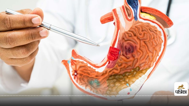 Excess salt may increase the risk of stomach cancer