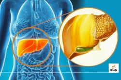 बिना दवाओं के Fatty liver से निजात पाएं, देखें यह वीडियो - image