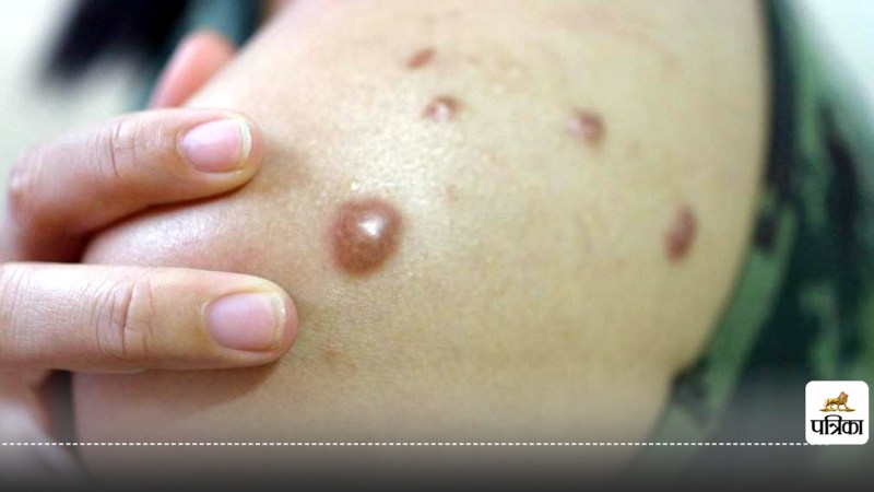 Indian Scientists Revolutionize Monkeypox Detection with New Method