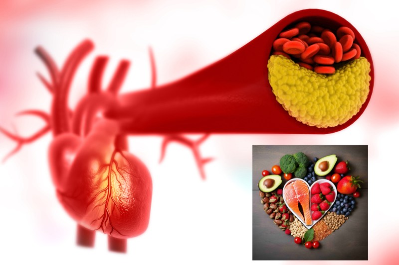 5 Superfoods That Prevent Clogged Arteries removes LDL cholesterol