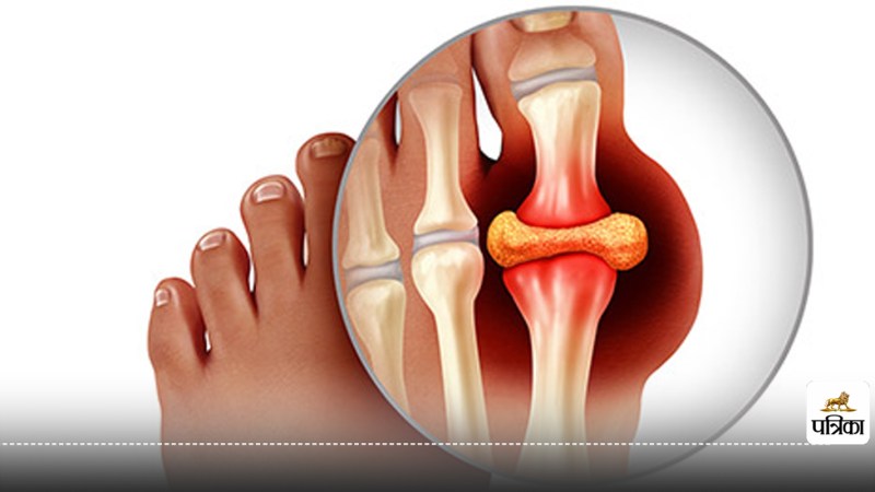 Reduce Uric Acid for Joint Pain Relief