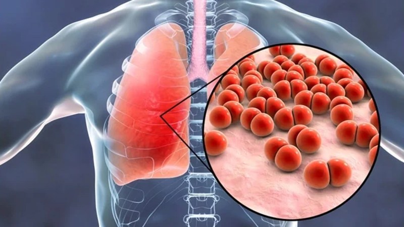 Pneumonia risk after Diwali : दिवाली के बाद निमोनिया का खतरा: कारण और सावधानियां