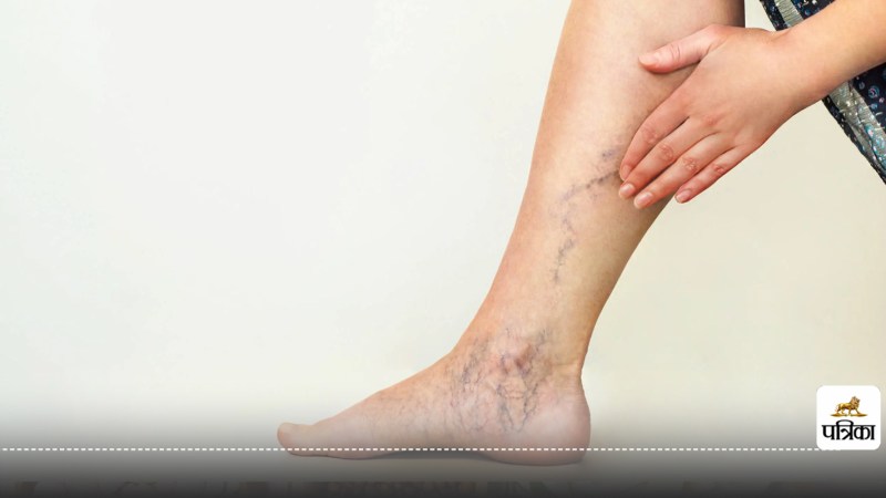 Varicose Veins treatment