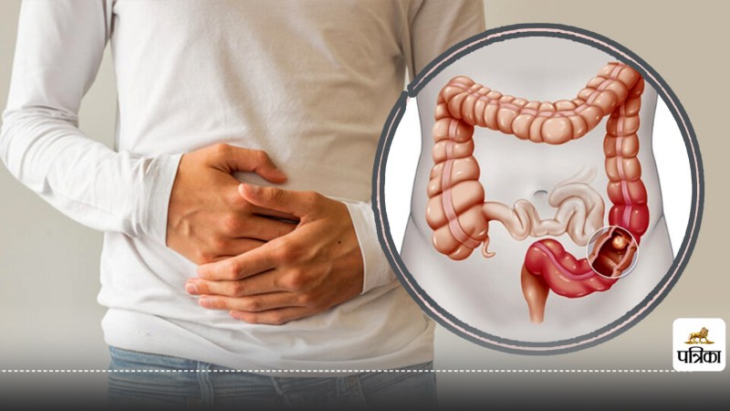 Colon cancer in young adults