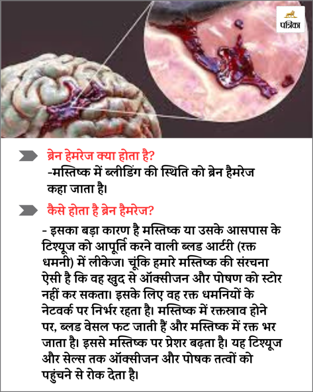 brain haemorrhage