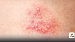 Genital Herpes Infection : हर सेकंड होता है एक व्यक्ति शिकार, क्या है इससे बचाव
का उपाय - image