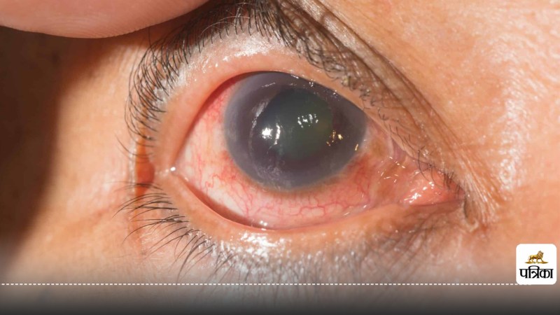 Glaucoma Prevention Regular Eye Check ups for Those Over 40 are a Must