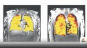 Lung Disease Diagnosis Simplified: Scientists Develop Real-Time Transplant
Monitoring Technique