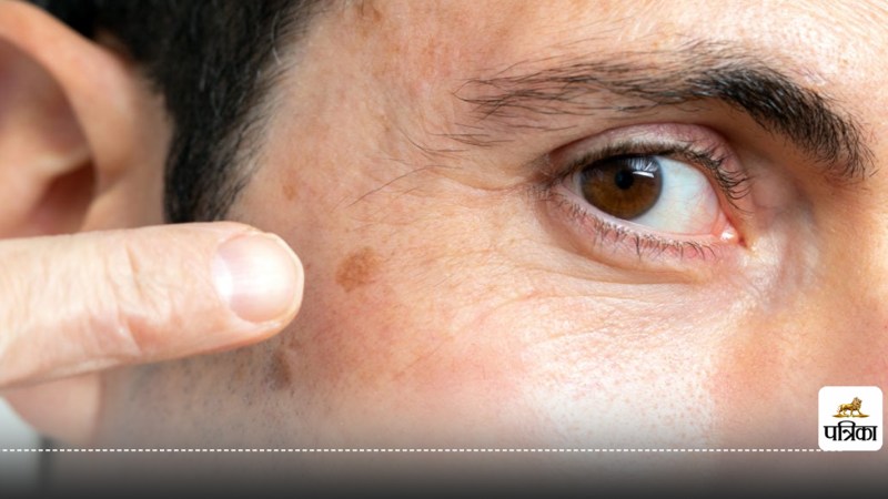 Moles on body causes cancer