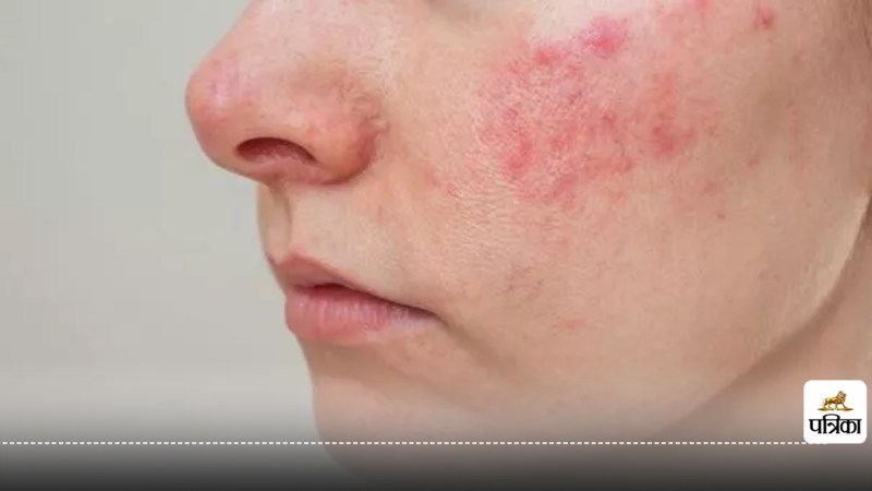 Symptoms of lung cancer