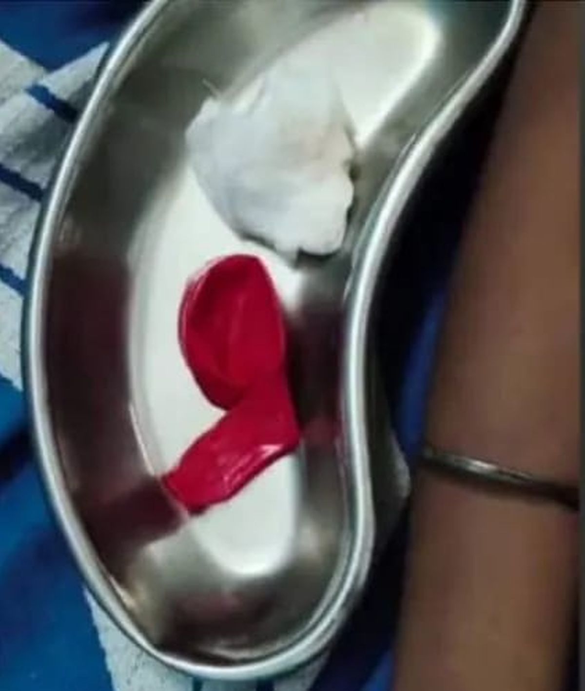 Balloon gets stuck in class 7 student’s throat, resulting in death