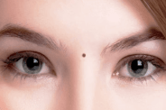 Moles on body