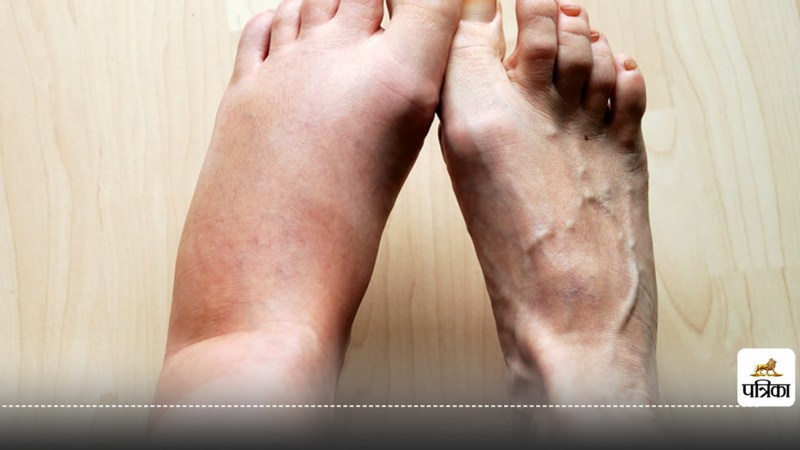 high cholesterol symptoms artery swelling in legs ankles feet