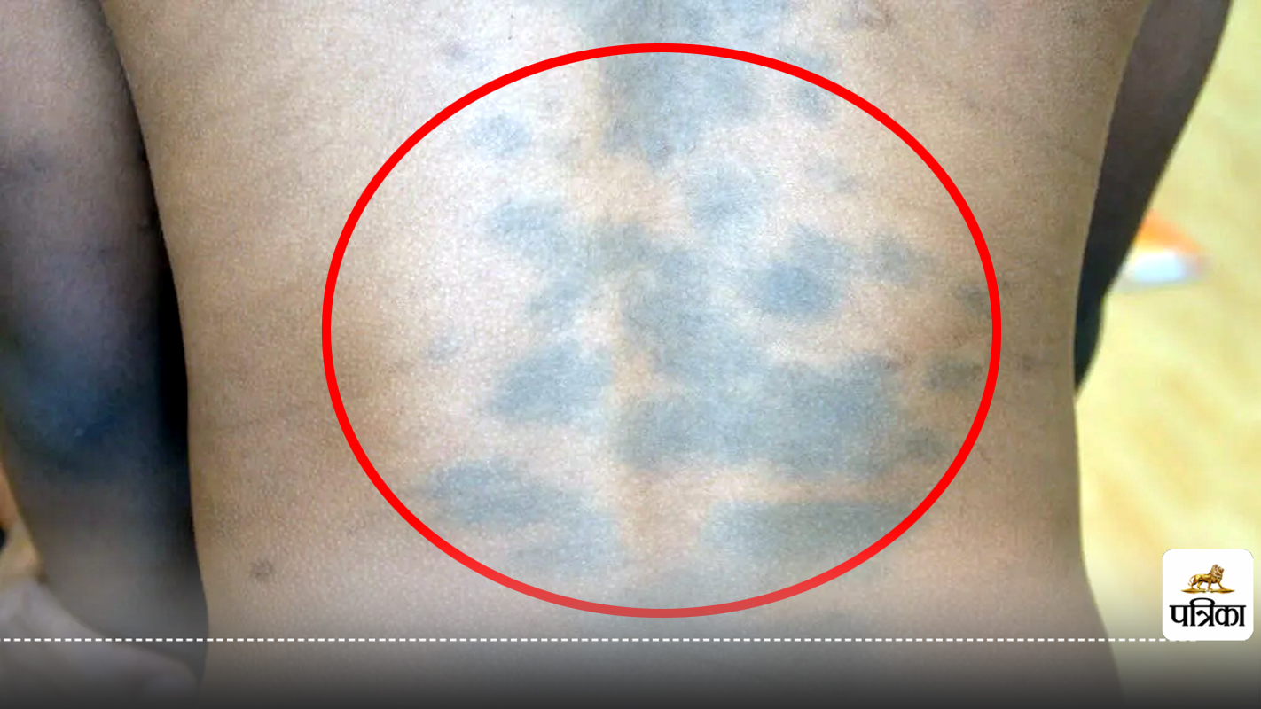 Blue Spots On Body: शरीर पर नीले धब्बे हो सकते हैं इस खतरनाक बीमारी के संकेत