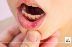 Cure Mouth Ulcers: आप भी मुंह में छालों से परेशान है, जानिए इसके पीछे का कारण और
बचाव उपाय - image