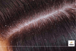 सर्दियों में Dandruff से परेशान है, फायदेमंद हो सकते हैं ये उपाय - image