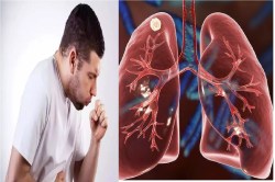 TB symptoms: बढ़ रहे टीबी के मरीज! संपर्क में आने से फैल रही बीमारी, जानें क्या
है इसके लक्षण… - image