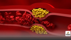 Bad cholesterol को कंट्रोल करने के आसान तरीके - image