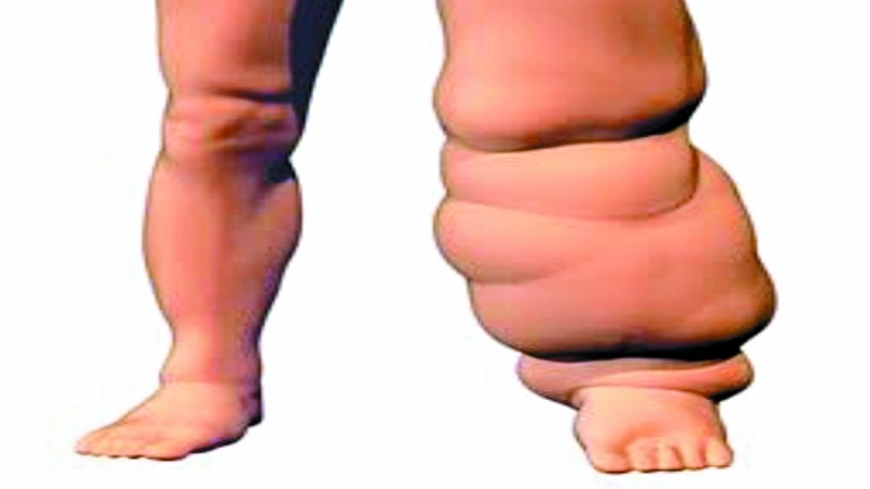 बालोद जिले में फाइलेरिया के 84 मरीज मिले हैं, जिनका इलाज चल रहा है। फाइलेरिया को हाथी पांव भी कहा जाता है।