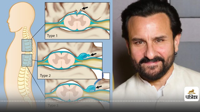 Saif Ali Khan Spinal Fluid Leakage