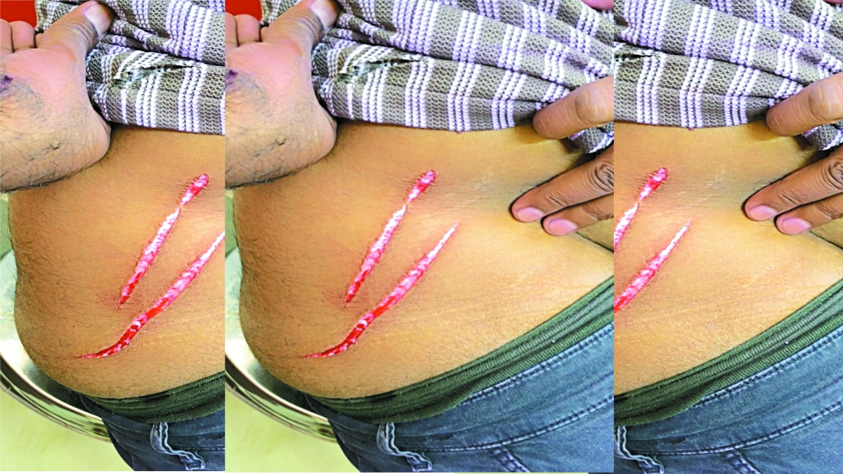 गुंडरदेही से लगी ग्राम पंचायत रेंगाकठेरा में हारे हुए सरपंच प्रत्याशी के बेटे ने जीते हुए सरपंच प्रत्याशी के विजय जुलूस में अपने दोस्त के साथ ब्लेड से हमला कर दिया।