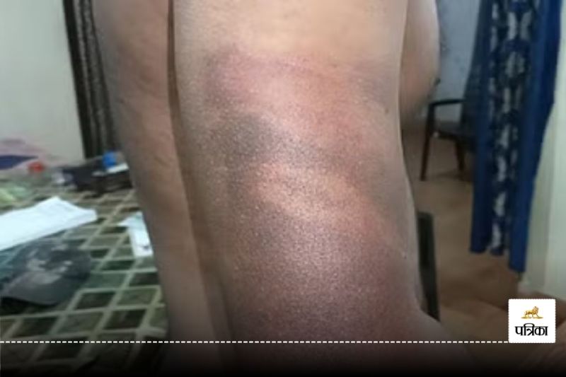 Korba Crime News: 108 एंबुलेंस के मैनेजर को बंधक बनाकर पीटा, सिर में लगे पांच टांके... वजह जानकर उड़ जाएंगे होश