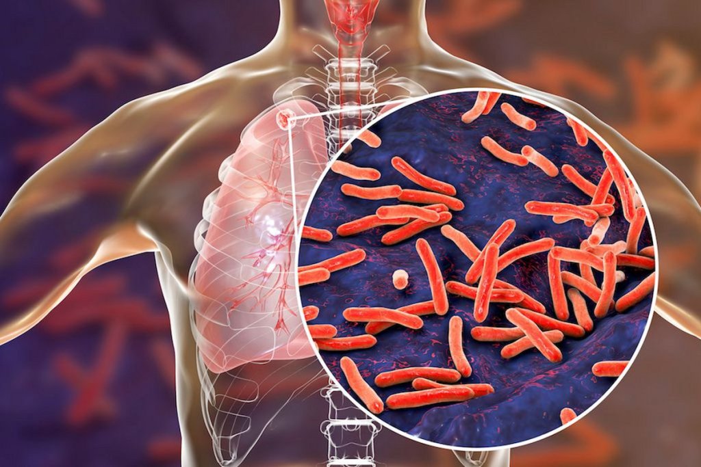 TB disease: चौंकाने वाले आंकड़े: सरगुजा में 6 साल में टीबी की बीमारी से 205 लोगों की मौत, हर साल मिल रहे 1100 मरीज