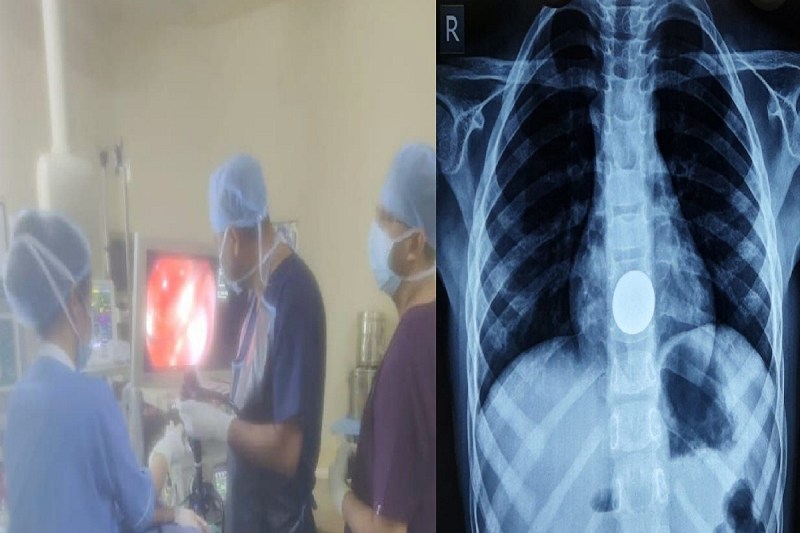 CG News: 8 साल के मासूम बच्चे ने निगला सिक्का, हालत खराब होने पर पहुंचा अस्पताल, फिर...