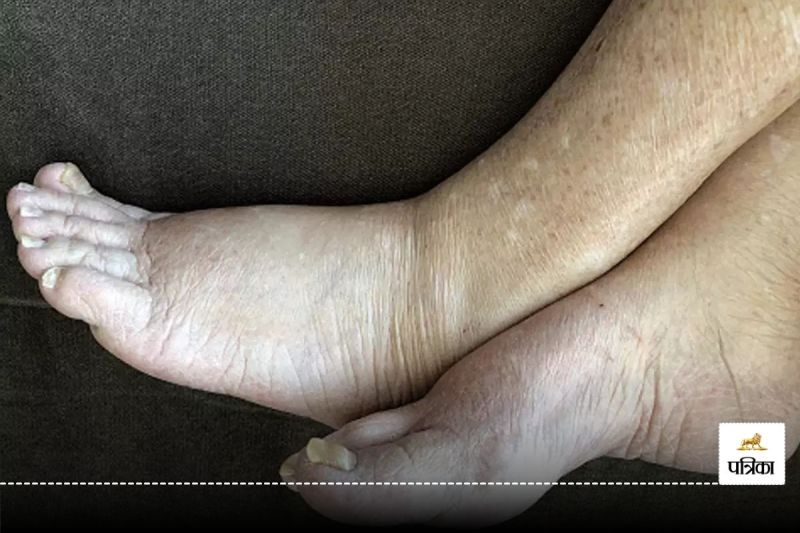 डेंगू-मलेरिया नहीं, अब इस बीमारी ने मचाया हाहाकार! कोविड की तरह फैल रहा संक्रमण, 273 बच्चें मिले संक्रमित