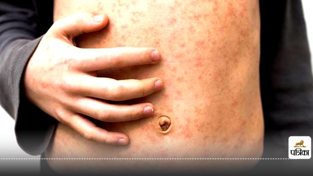 Measles symptoms and treatment