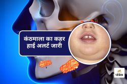 Mumps outbreak in children : ये हैं लक्षण और संक्रमण का तरीका, कैसे करें बचाव - image