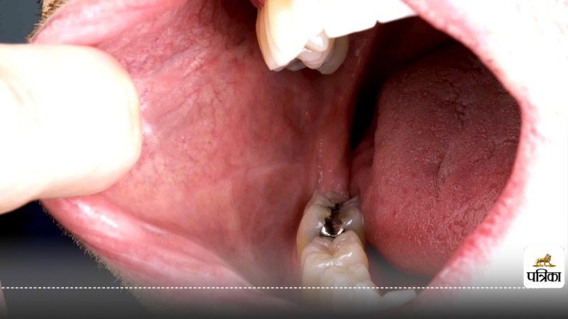 Oral cancer causes