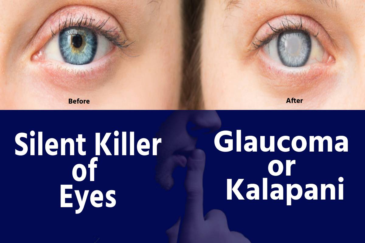 Silent Killer Of Eyes Glaucoma or kalapani