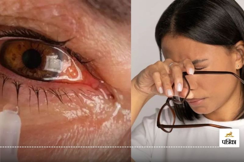 बस्तर में Eye Flu का बढ़ा खतरा! 1200 से अधिक मामले आए सामने, ये बरतें सावधानी...