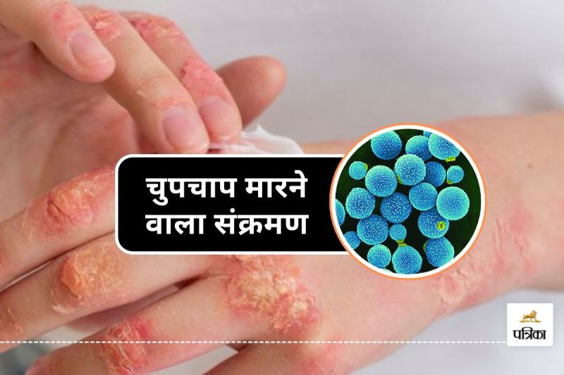 WHO First Report on Fungal Infections Shocking 88 percent Mortality Rate Revealed