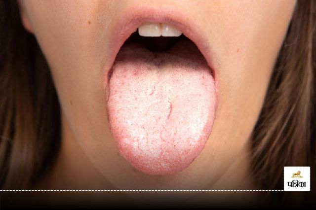 White Tongue