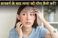 How to fix sunburned skin at home